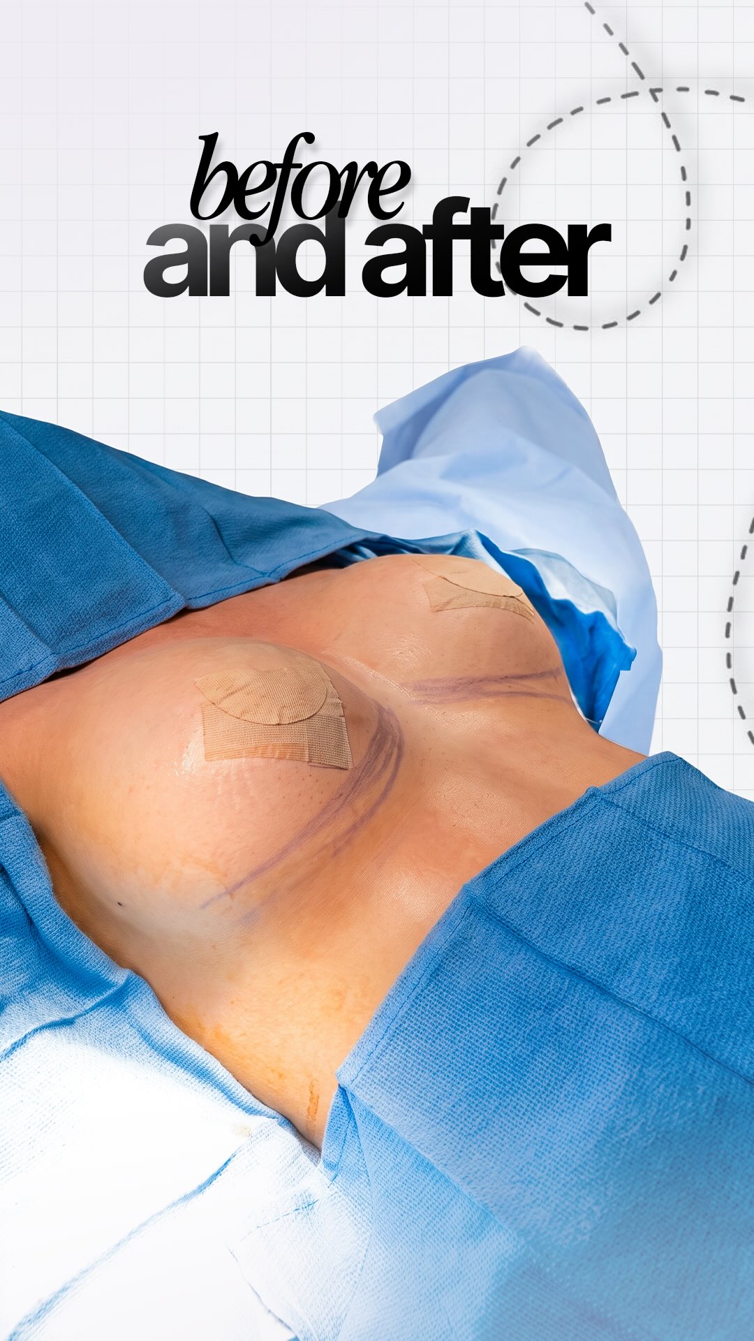 🤍Confidence looks beautiful at every angle.
A stunning before & after breast augmentation
by Dr. Bo